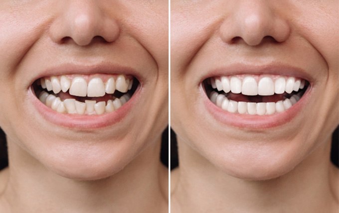 Before and after of cosmetic dentistry