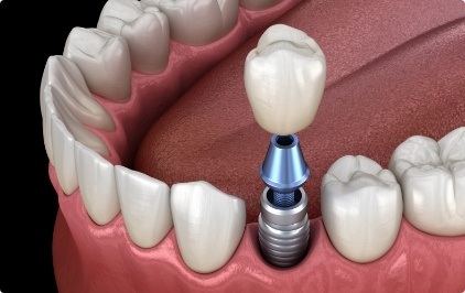 Animated dental implant with dental crown replacing one missing tooth