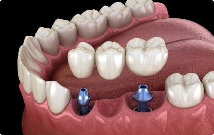 Two animated dental implants with dental bridge replacing three missing teeth