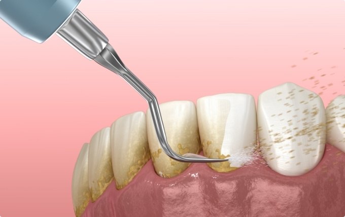 Animated dental tools removing plaque from teeth during gum disease treatment in Moorestown