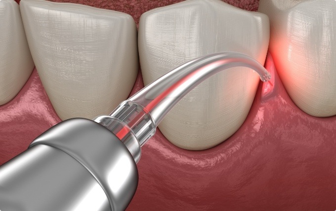 Animated dental laser treating gum disease