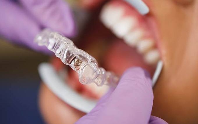 Dentist placing Invisalign aligner