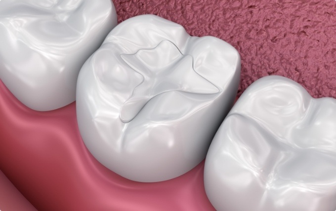Close up of animated tooth with dental sealants