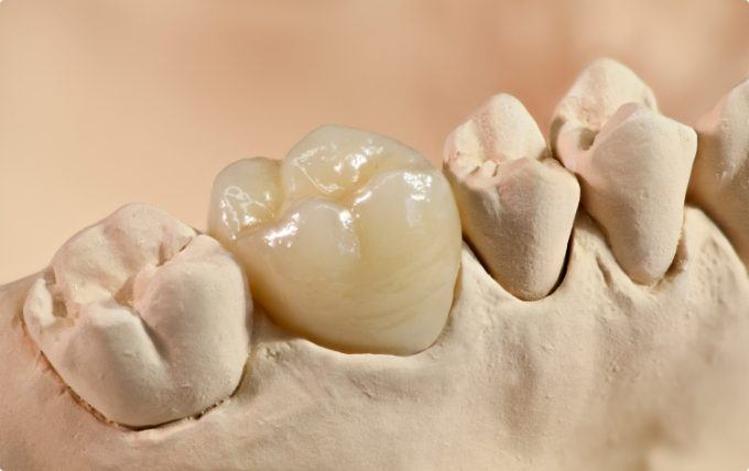Dental crown on model of lower arch of teeth