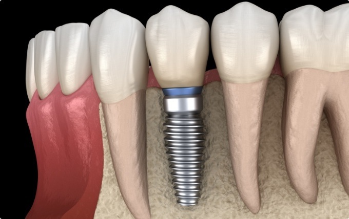 Animated dental implant with dental crown replacing a missing tooth in Moorestown