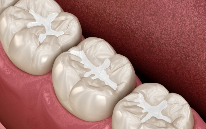 Animated row of teeth with tooth colored fillings