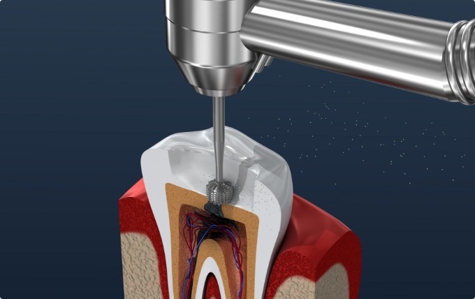 Animated dental tool performing root canal treatment in Moorestown on animated tooth