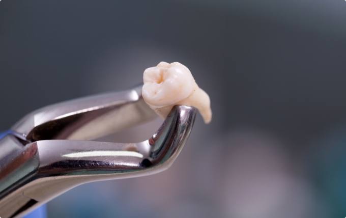 Tooth being held in dental forceps after tooth extraction in Moorestown