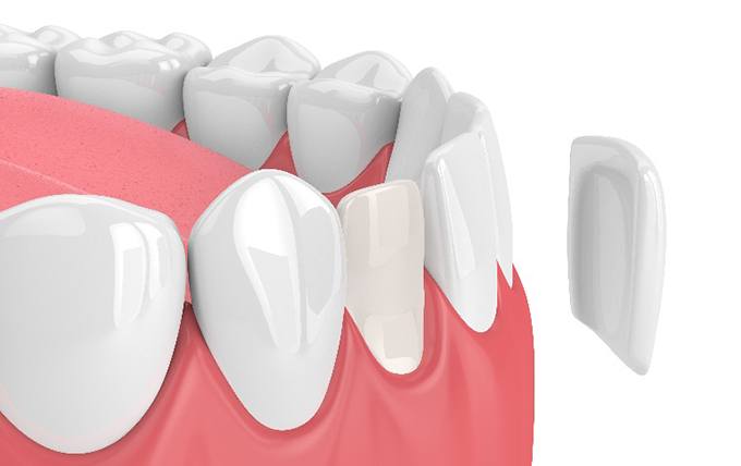 Illustration of veneer being placed on lower, front tooth